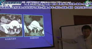 柳健公开课影像学腰椎间盘突出视频教程-百度网盘下载-中医教程博客
